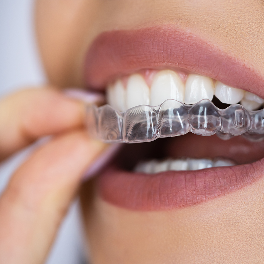 Unsichtbare Zahnkorrekturen mit Invisalign® Unsichtbare Zahnkorrekturen mit Invisalign®